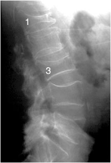 multiple vertebral complression fracture.png